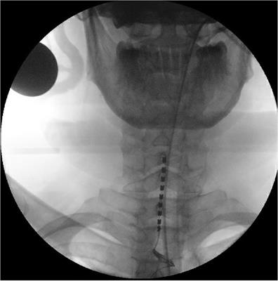 Spinal cord stimulation for refractory pericarditis: a case report and a review of the mechanism of action